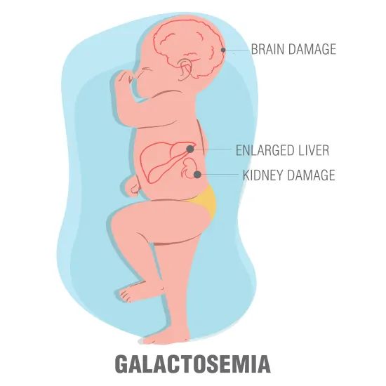 Galactosemia Classic Transferase